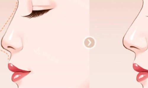 垫鼻子的前后对比动画图