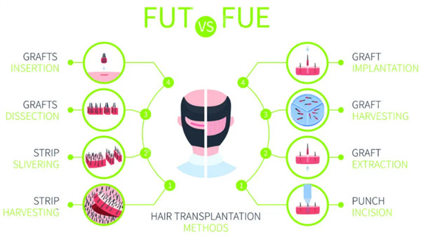 两种植发技术图解
