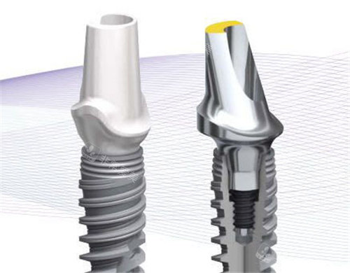 诺贝尔种植牙示意图