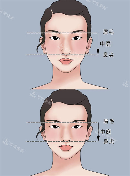 正常鼻子和過長鼻子矯正對比