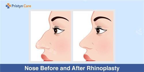 驼峰鼻矫正前后