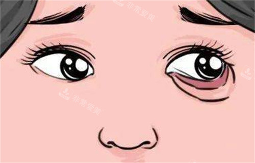 下眼睑外翻 下眼睑外翻