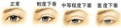 上睑下垂分级.webp