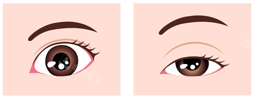 上睑下垂的样子图解