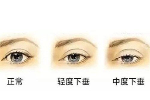 上睑下垂程度展示图