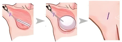 假体隆胸术图 假体隆胸术图