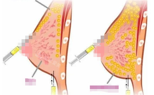 胸部脂肪填充过程呈现图