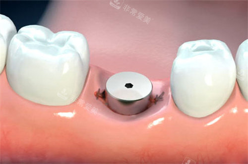 单颗种植牙愈合基台卡通图