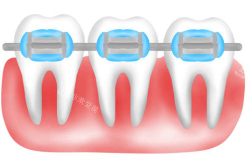 自锁矫正卡通图