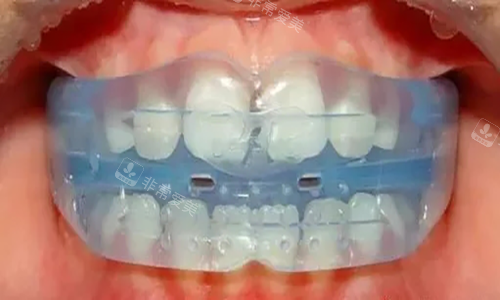 MRC儿童牙齿早期干预矫治器