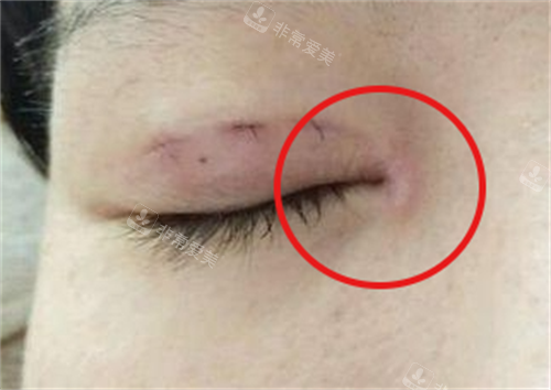眼角疤痕增生实例图