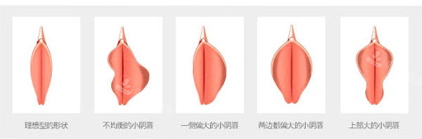 不同阴唇形状情况照片