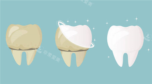 牙齿清洗前后对比