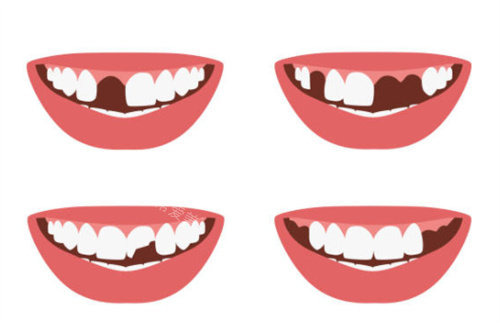 牙齿缺失图