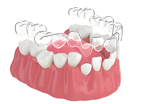 牙齿隐形矫正图片