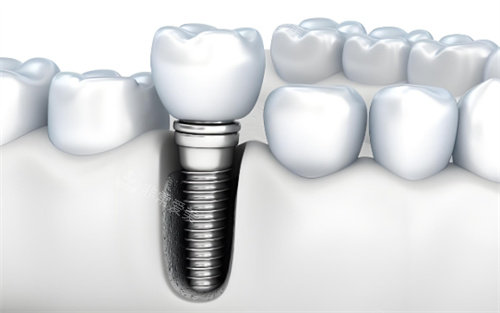 种植牙动画图片展示图