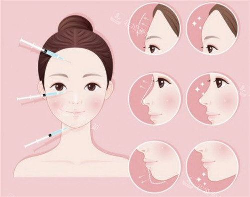 鼻基底凹陷可以用填充方式改善