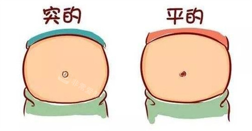 肚脐整形可改善的肚脐