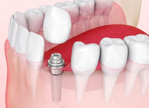 种植牙清晰展示