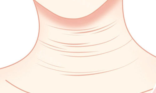 韩国打颈纹玻尿酸1cc保柔缇真值得！颈纹从“项链痕”到平滑，注射层次准且无淤青，附价格与维持时间揭秘！