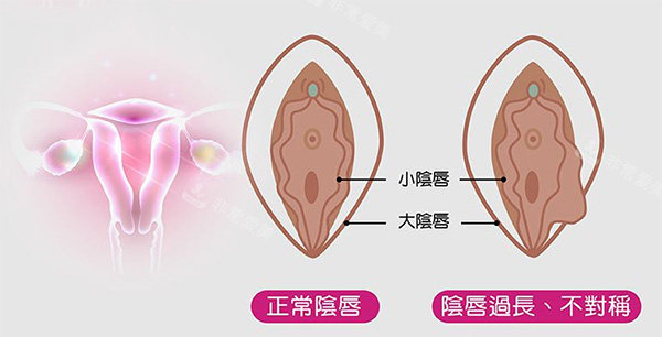 阴唇不对称改善照片
