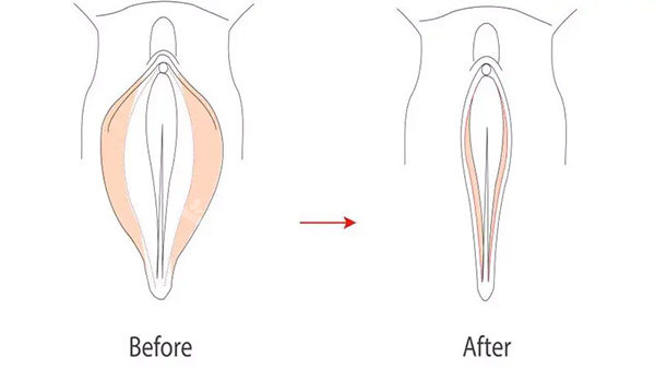 阴唇改善美观照片 阴唇改善美观照片