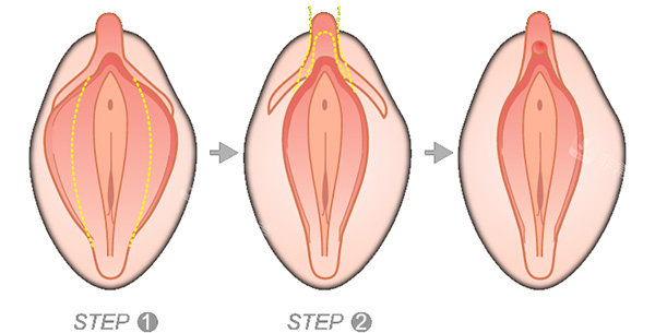 大阴唇手术怎么做 大阴唇手术怎么做