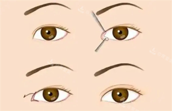 开眼角整形手术 开眼角整形手术