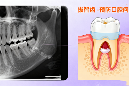 拔智齿卡通展示图