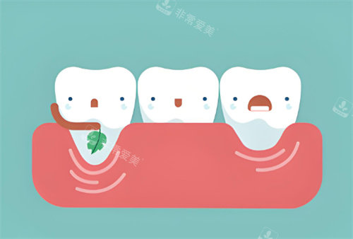 牙龈萎缩卡通示图