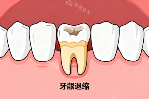 牙龈萎缩展示图