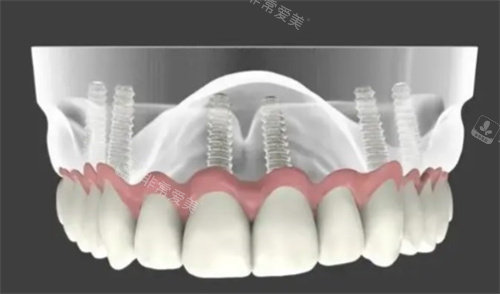 全口种植牙解析图