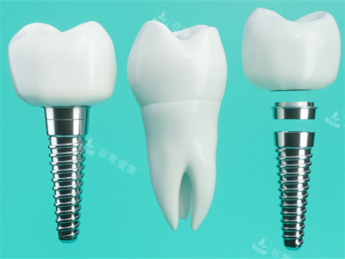 种植牙和真实牙齿漫画示意图