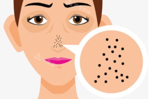 鼻子毛孔粗大卡通图