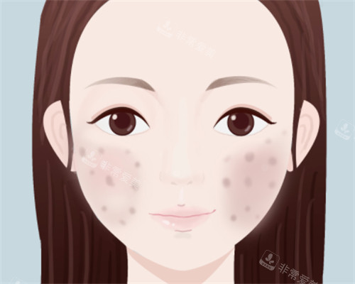 脸上痘印怎么办