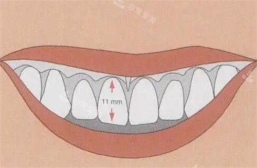 牙冠延长图片照片
