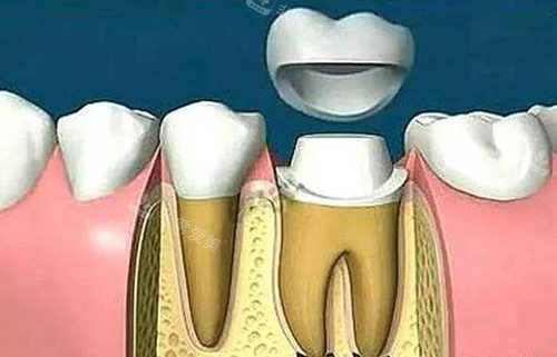 牙冠治疗过程示意图