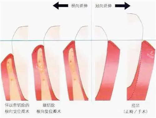 牙冠延长对比展示图
