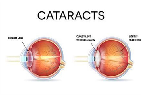 健康眼与白内障眼对比