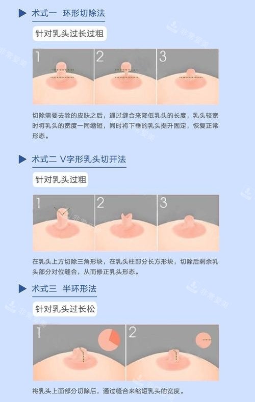 乳头缩小术切口演示动画图
