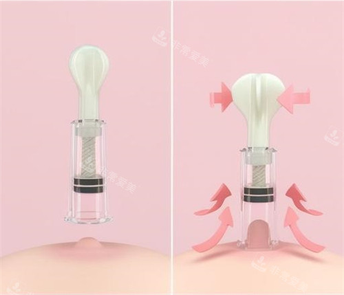 乳头内陷矫正器使用方式