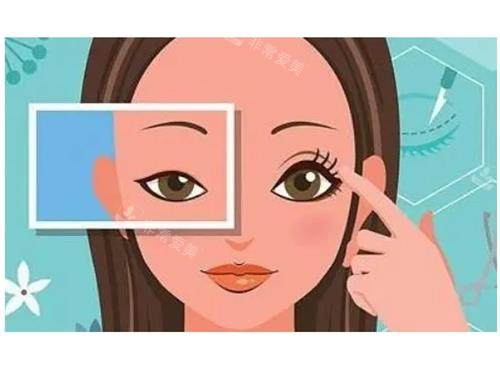 开眼角明显对比效果图