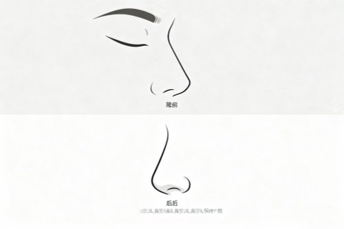 昆明韩辰陈曦做鼻子怎么样？27年临床经验+中韩技术融合，硅胶/膨体/肋软骨多材料适配！