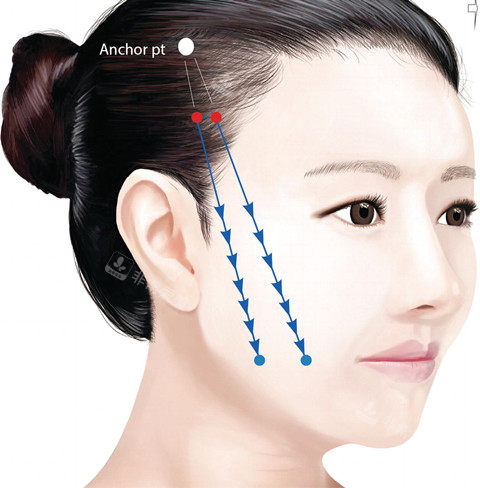面部线提升卡通图