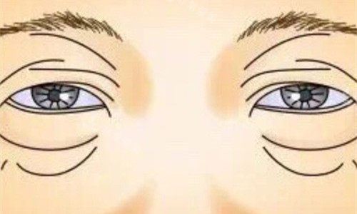 眼袋展示卡通图