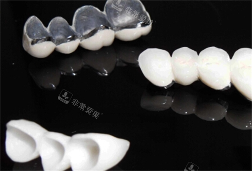 不同种类烤瓷牙模型展示