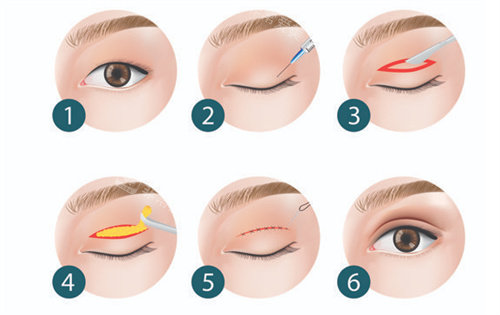 双眼皮全切手术过程 双眼皮全切手术过程