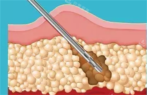 吸脂手术剖面演示图