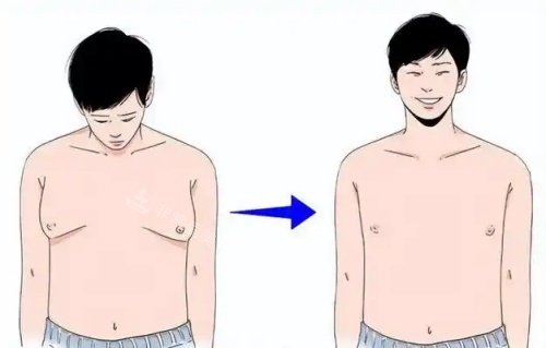 男性乳房发育吸脂前后示意图