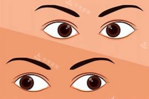 内斜视对比外斜视